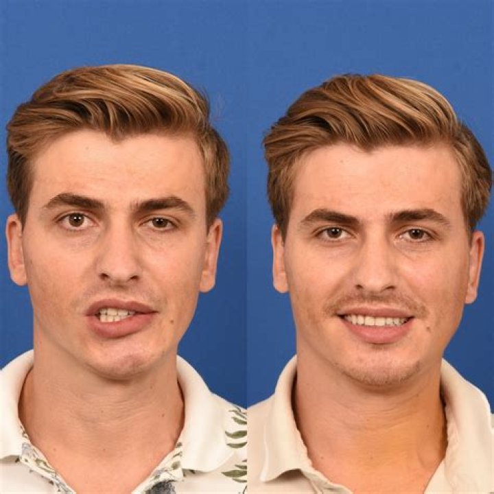 Why Is Hafthors Face Paralyzed? – Celebrity